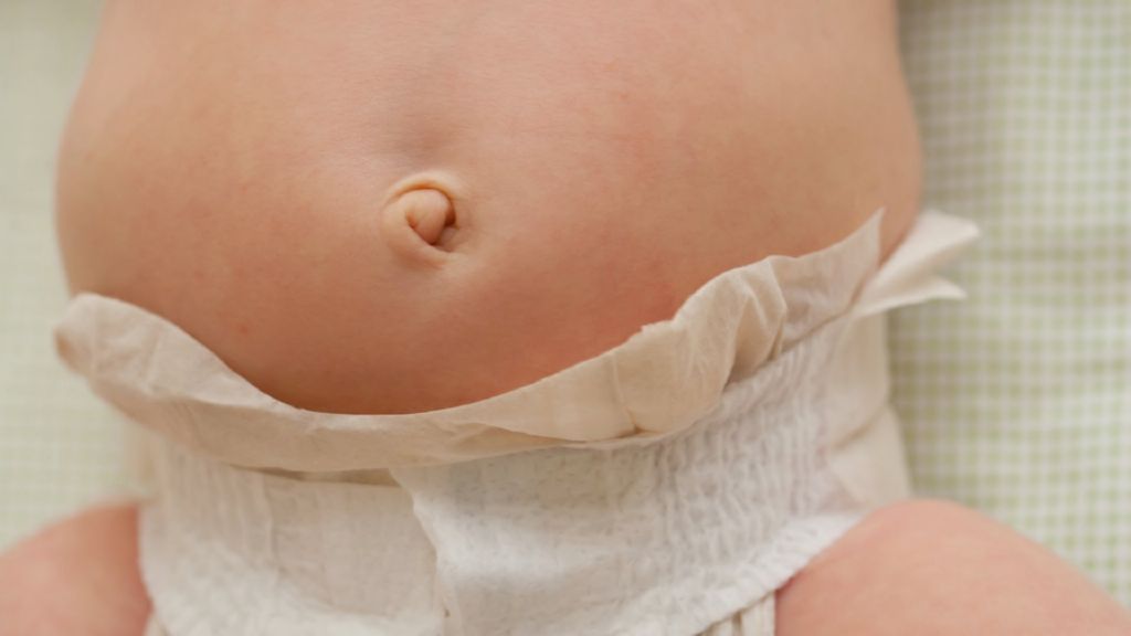 Hérnia umbilical no bebê: o que é e como tratar - OSTEOBABY